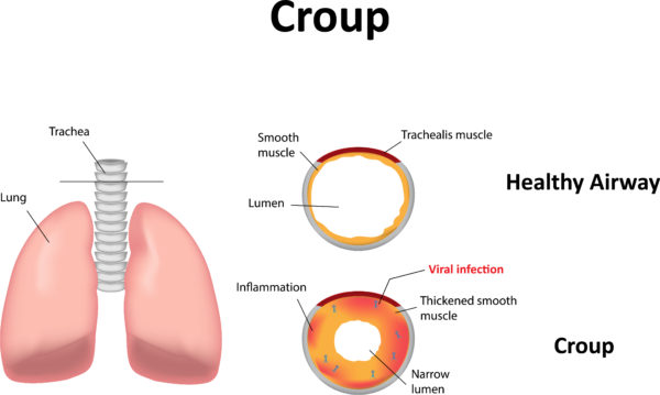 croup-in-children-urgent-care-kids-near-me-pediatric-urgent-care