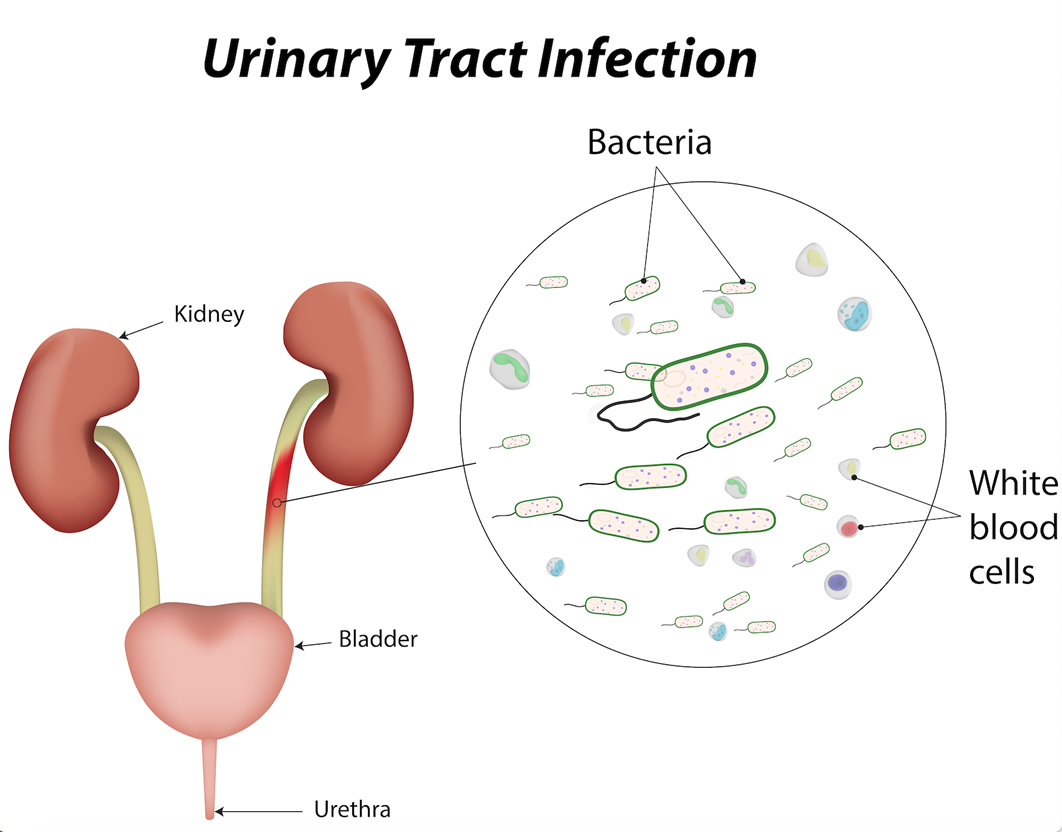 Urinary tract infections in children | UTI Symptoms Kids 