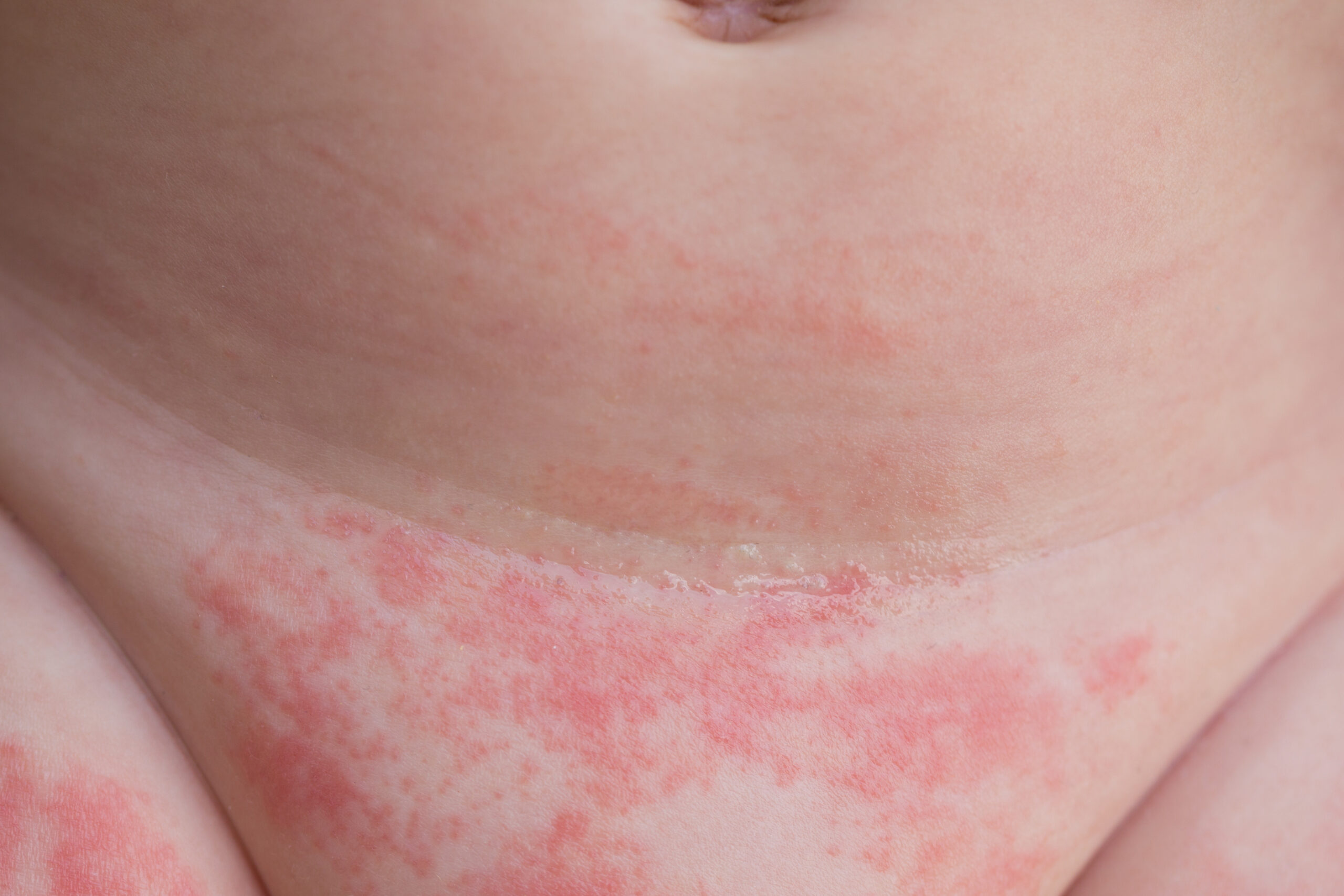 Skin Rashes / Skin Infection • Houma And Bayou Vista, LA • Delta Urgent Care