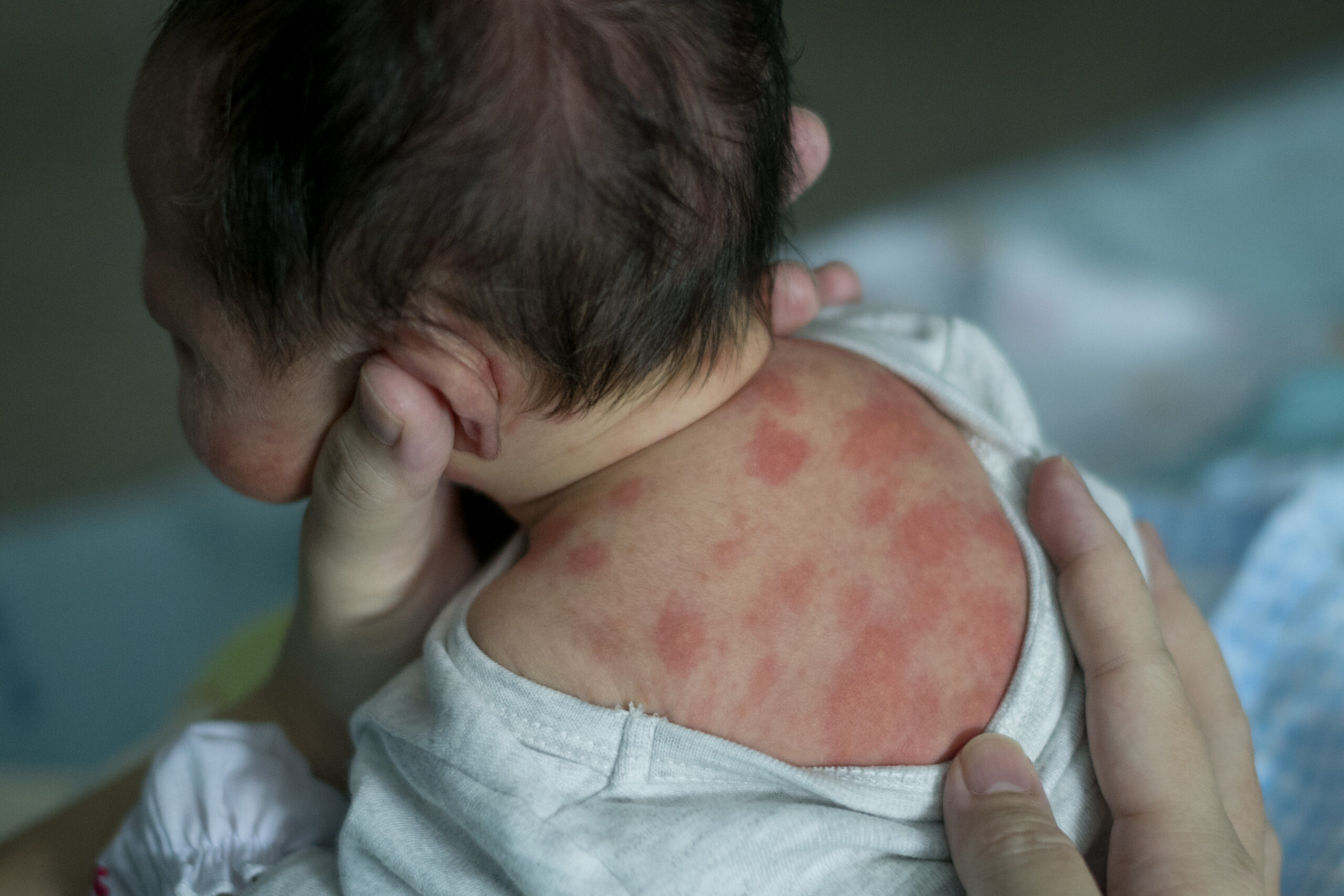 cashew allergy skin rash babies