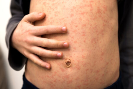 Measles Outbreak Spreads in Texas: Little Spurs Monitoring Situation Closely - Excelente Atención Pediátrica de Urgencia en Texas - Clínicas Little Spurs de Atención Pediátrica de Urgencia